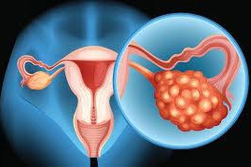 Xét nghiệm máu phát hiện sớm ung thư buồng trứng