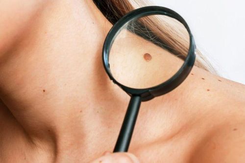 5 vị trí nốt ruồi trên cơ thể có thể biến thành ung thư, ai cũng có nguy cơ cao: Đừng chủ quan, hãy kiểm tra ngay
