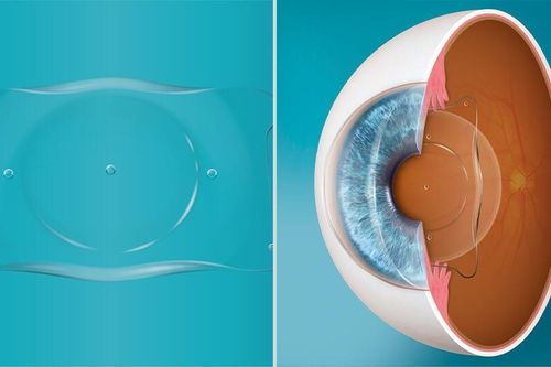 Tiên phong triển khai Phakic ICL Precision+: Đột phá mổ cận cá nhân hóa