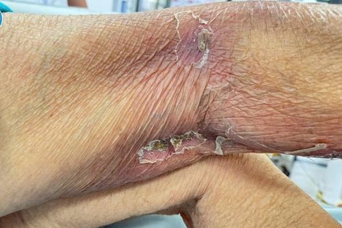 Sốc nhiễm khuẩn, ngừng tim vì vết đốt 'tử thần'