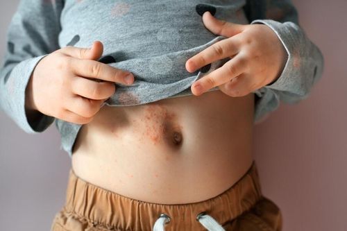 Dấu hiệu cảnh báo bệnh ghẻ ở trẻ