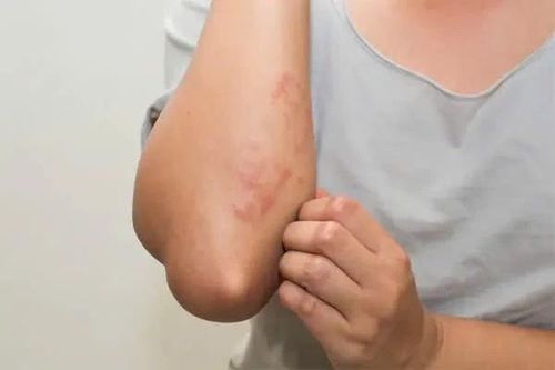 Giải mã lý do nhiễm khuẩn đường huyết có tỷ lệ tử vong cao