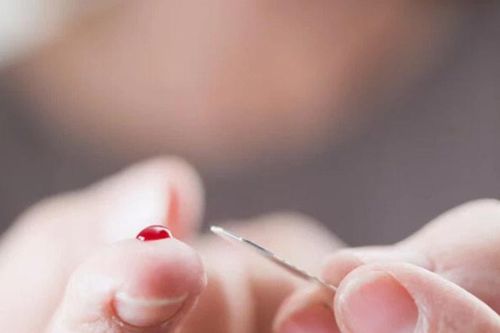Chồng nguy kịch do vợ chích máu đầu ngón tay chữa đột quỵ