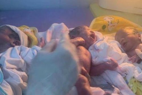 Lần đầu tiên Bệnh viện Tuyên Hóa mổ thành công ca sinh 3 tự nhiên hiếm gặp