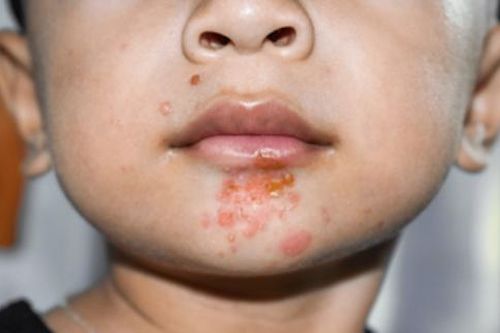 Bệnh chốc nguy hiểm thế nào?