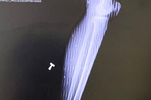 Người đàn ông đau đầu, đau mỏi cơ triền miên, đi khám, bác sĩ phát hiện bí mật đáng sợ