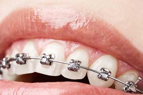 Phân biệt niềng răng mắc cài kim loại buộc chun và tự đóng