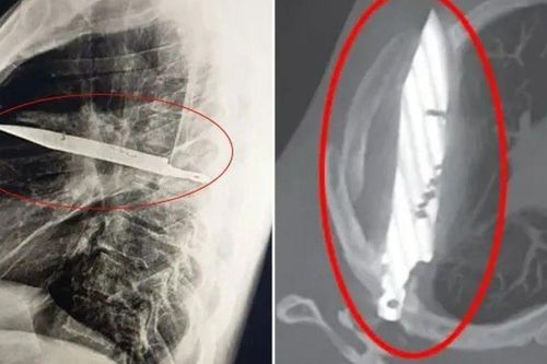 Người đàn ông sống sót kỳ diệu với lưỡi dao cắm trong ngực suốt 8 năm mà không hề hay biết