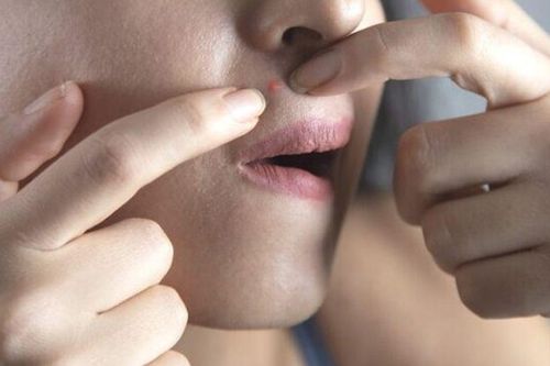 Nặn mụn, cô gái trẻ nguy kịch phải nhập viện: Cảnh báo chớ nặn mụn ở vùng 'tam giác tử thần' nếu không muốn mất mạng