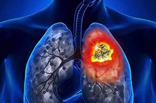 Ung thư phổi đau ở đâu, dấu hiệu cảnh báo căn bệnh này