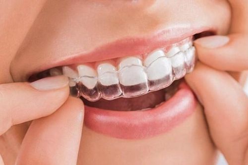 Loại mắc cài nào tốt nhất để niềng răng?