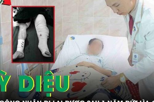 Một năm sau tai nạn đứt lìa chân, nam công nhân đã đi lại trên chính đôi chân của mình