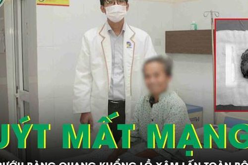 Trì hoãn điều trị, người đàn ông suýt mất mạng vì khối bướu bàng quang khổng lồ xâm lấn toàn bộ thận