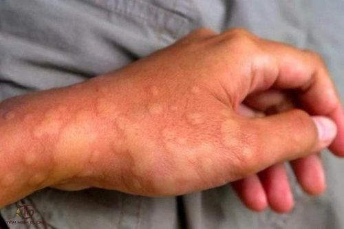 Nguyên nhân nổi mề đay, cách phòng tránh