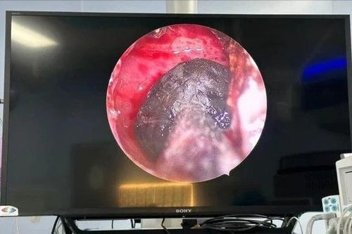 Phát hiện nấm xoang bướm sau nhiều tháng đau đầu âm ỉ