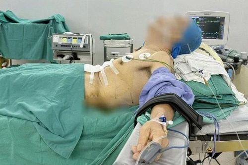 Ca phẫu thuật đặc biệt cho bệnh nhân ung thư dạ dày lại gù vẹo cột sống nặng