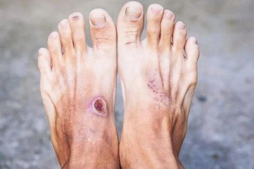Bước đột phá mới trong điều trị bệnh tiểu đường tuýp 1
