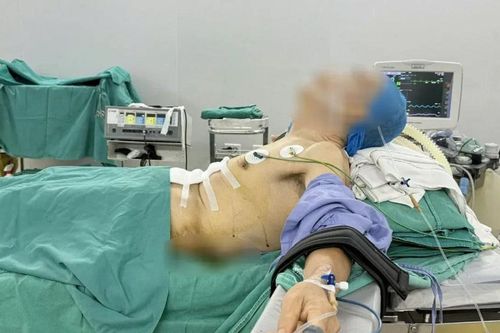 Phẫu thuật ung thư dạ dày cho bệnh nhân gù vẹo cột sống