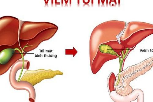 Người phụ nữ 44 tuổi ở Hà Nội bị viêm nhiễm, hoại tử gây thủng túi mật vì chủ quan bỏ qua dấu hiệu này