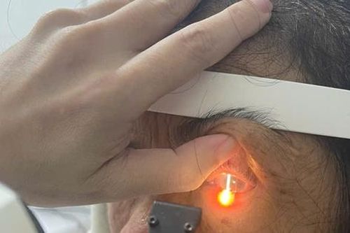 Bỏng mắt vì gội đầu bằng rượu ngâm hạt na