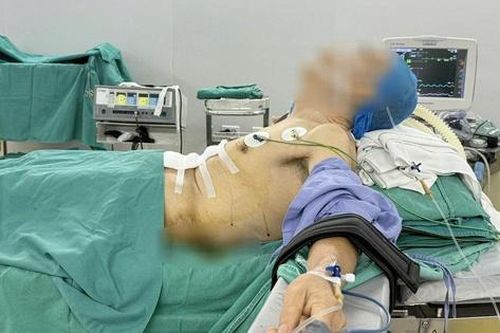 Bệnh nhân 'nửa nằm, nửa ngồi' trong ca phẫu thuật ung thư dạ dày