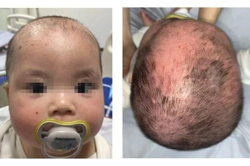 Cảnh giác biến chứng nặng do điều trị viêm da cơ địa, viêm da đầu sai cách