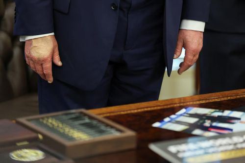 Ông Trump che giấu vết bầm trên tay