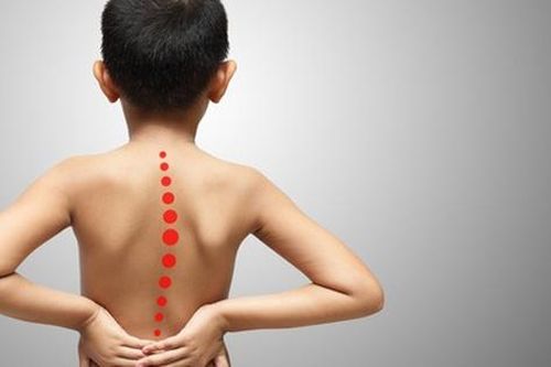 Vẹo cột sống phát hiện như thế nào?
