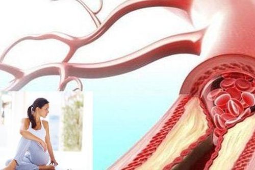 4 thay đổi lối sống hàng đầu giúp giảm nguy cơ tắc nghẽn động mạch
