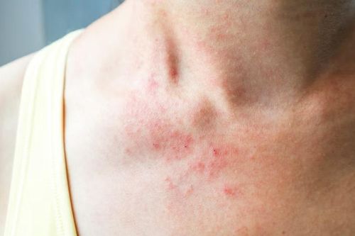 Nhận diện nốt phát ban nguy hiểm