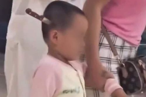 Bé 3 tuổi đi bộ vào bệnh viện Trung Quốc với con dao cắm vào đầu