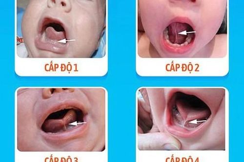 Dị tật bẩm sinh khiến trẻ khó bú, khó phát âm