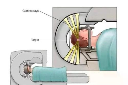 Các loại ung thư dễ di căn não