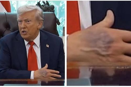 Bàn tay thâm tím của ông Trump gây chú ý