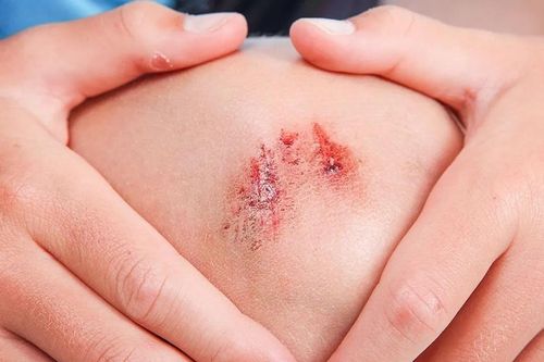 Căn bệnh nguy hiểm chỉ từ vết thương nhỏ