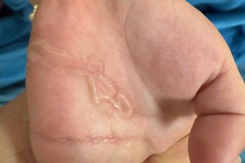 Sán ký sinh, nổi ngoằn ngoèo dưới da bé trai