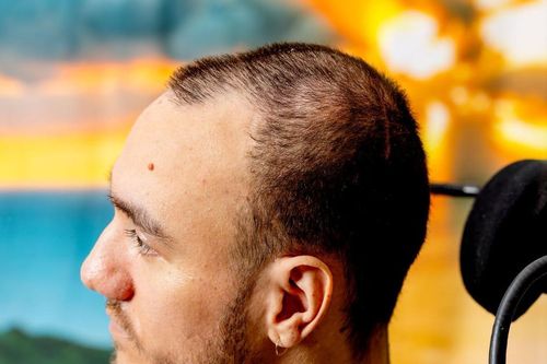 18 tháng sau khi cấy chip não Neuralink, 'người tham gia số 1' hiện thế nào?