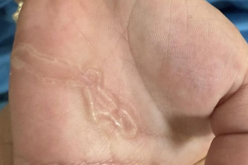 Bàn tay bé trai xuất hiện dấu hiệu lạ sau lần nghịch cát