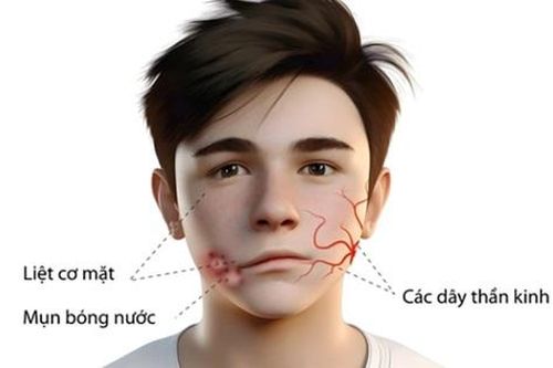 Liệt mặt do zona có biểu hiện như thế nào?
