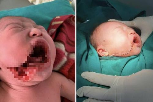 Những nỗ lực chăm sóc bà mẹ, trẻ em ở Lũng Cú và câu chuyện lay động cứu sống bé sơ sinh bị rạch một vết sâu vào má
