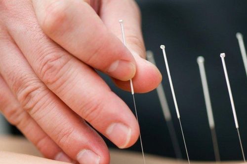 Châm cứu để chữa đau lưng