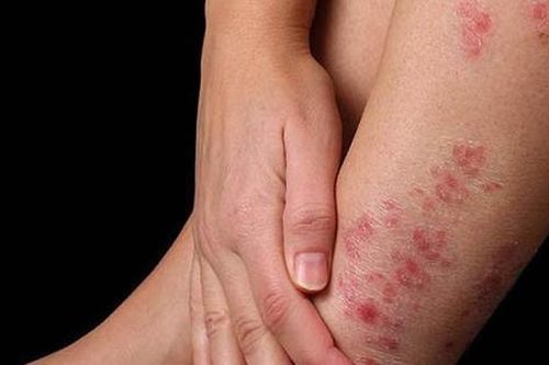 Phát hiện sớm bệnh ngoài da mùa mưa lũ