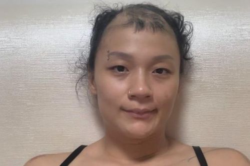 12 năm tự nhổ tóc chính mình