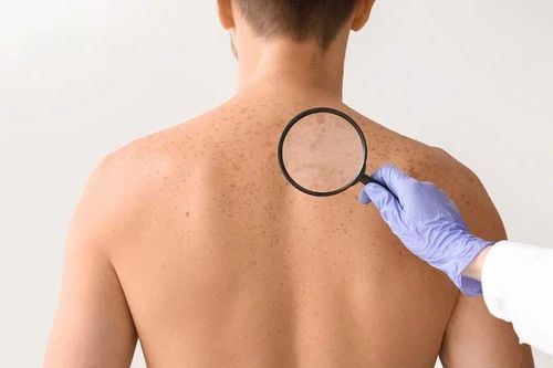 Thay đổi nhỏ trên da cảnh báo nguy cơ ung thư