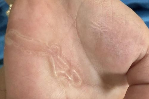 Bé trai 4 tuổi xuất hiện 'đường ngoằn ngoèo' trên tay, nhập viện vì nhiễm sán máng