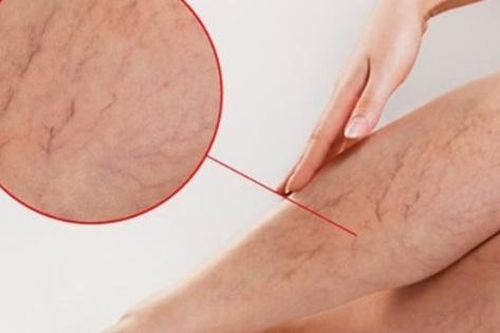 Suy giãn tĩnh mạch: Đừng mắc sai lầm để phải chấp nhận sống chung với bệnh