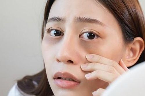 Quầng thâm dưới mắt – Cảnh báo thiếu hụt chất dinh dưỡng nào?