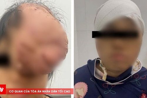 7 giờ loại bỏ khối u sụn xương sọ khổng lồ cho một bệnh nhân nữ