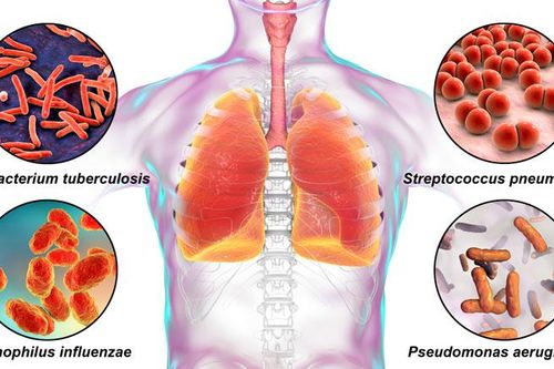 Vì sao phế cầu khuẩn được mệnh danh là 'kẻ giết người thầm lặng'?