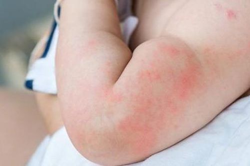 Cảnh báo: Trẻ em sốt phát ban – những dấu hiệu nhận biết sớm, cha mẹ không được chủ quan